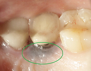 金属溶出した状態（歯ぐきの黒ずみ）写真
