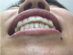 噛み合わせた時の上下の歯の前後距離がわかる写真