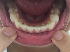 噛む面がよく見える下の歯の写真