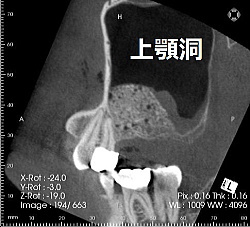 サイナスリフト後画像