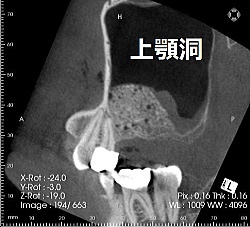 サイナスリフト後画像