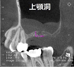 サイナスリフト前画像