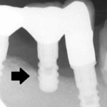 インプラント周囲炎レントゲン写真