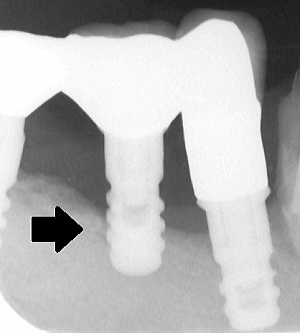 インプラント周囲炎レントゲン写真