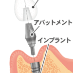 インプラント