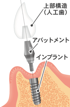 インプラント