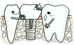 インプラント