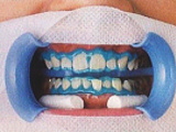歯肉保護材塗布写真2