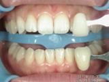 歯の色の確認写真